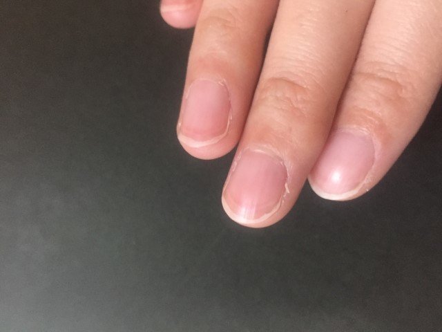 ささくれの原因と対処法や治療法!化膿して放っていても大丈夫なの?